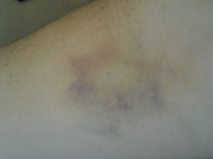 Hematoma antebrazo
